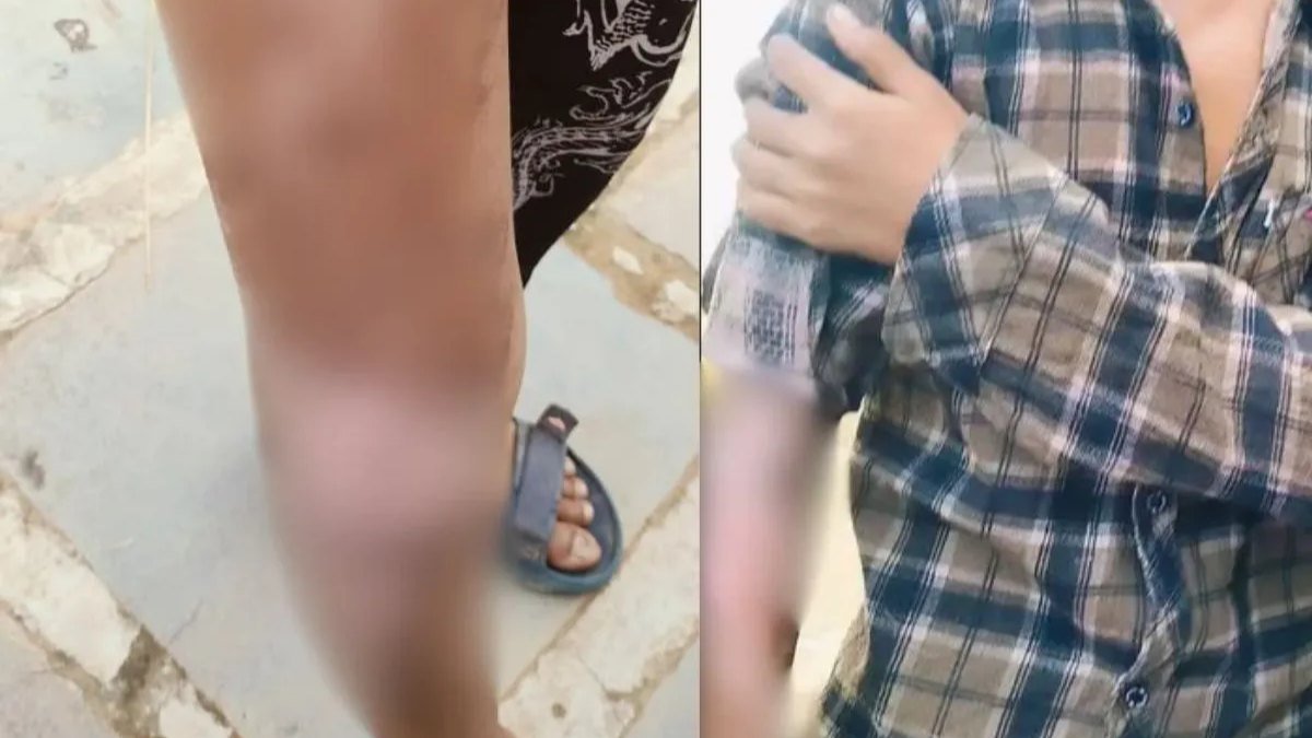आदिवासी छात्रावास में दो छात्र गर्म दाल से झुलसे,  परिजनों को सूचना नहीं देने के आरोप से उठे गंभीर सवाल